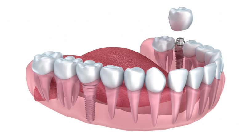 Visa tiesa apie dantų implantus: kai kokybė svarbiau nei kaina 