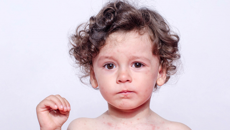 JK nerimą keliančiu greičiu daugėja vaikų, kuriems pasireiškia ūmi alerginė reakcija