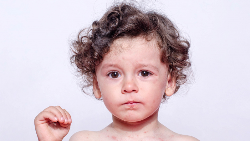 Koronavirusas JK: vaikams pasireiškia reta į Kavasakio ligą panaši komplikacija