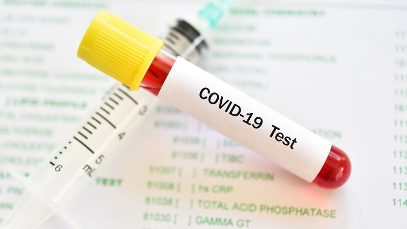 Iš valstybės aprobuotų koronaviruso testus darančių įmonių sąrašo JK bus pašalinta per 50 įmonių