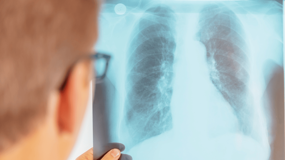 Europoje sparčiai daugėja tuberkuliozės atvejų