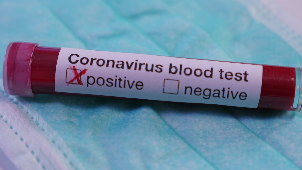 Ekspertas: JK dėl itin užkrečiamos atmainos gali padaugėti koronaviruso atvejų