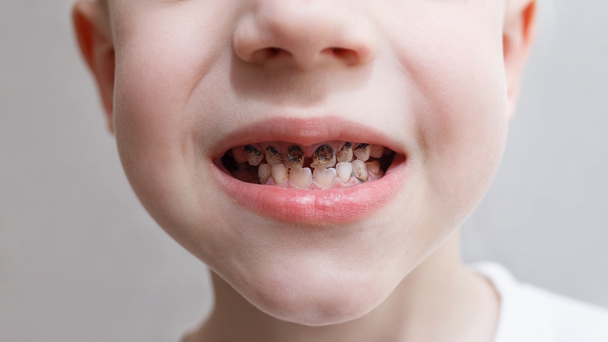 Kas šeštas vaikas JK pradinę mokyklą baigia turėdamas sugedusius dantis