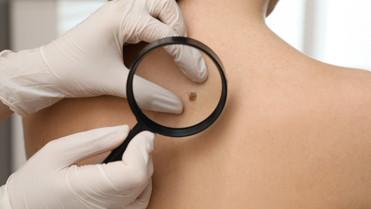 Perspėjimas JK gyventojams: melanomos atvejų skaičius – rekordinis