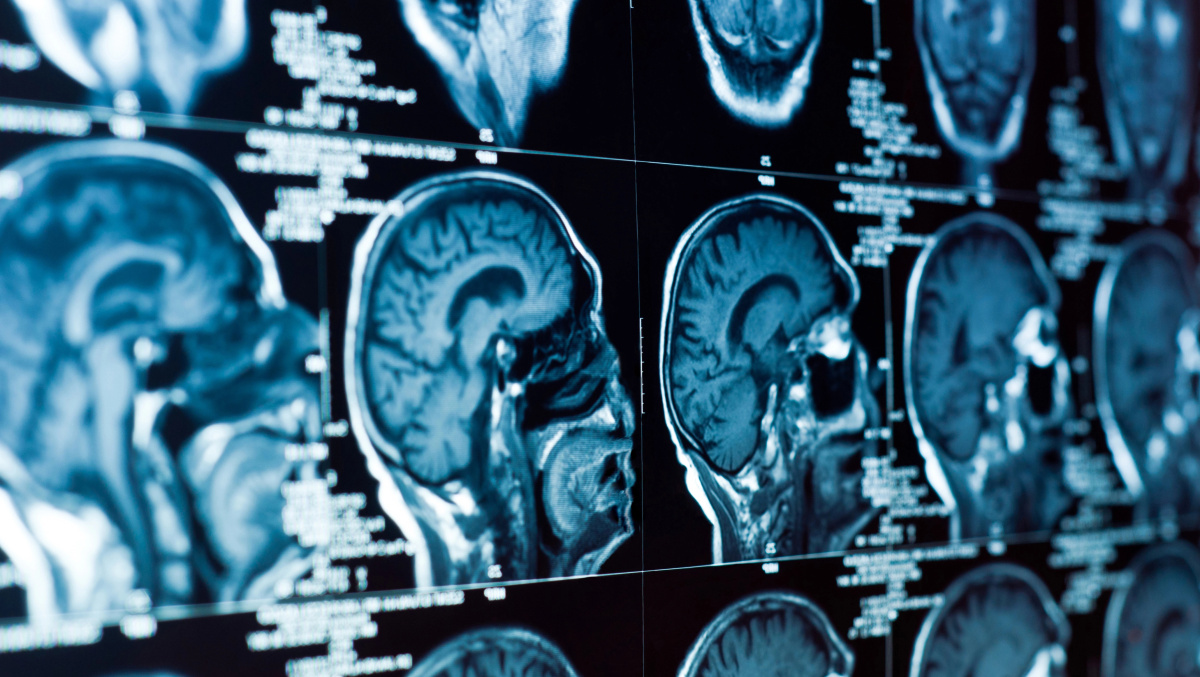 JK išbandomas revoliucinis smegenų vėžio tyrimas: diagnozės nustatymą sutrumpina nuo savaičių iki valandų